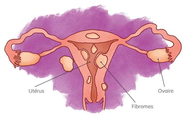 Utérus avec des fibromes