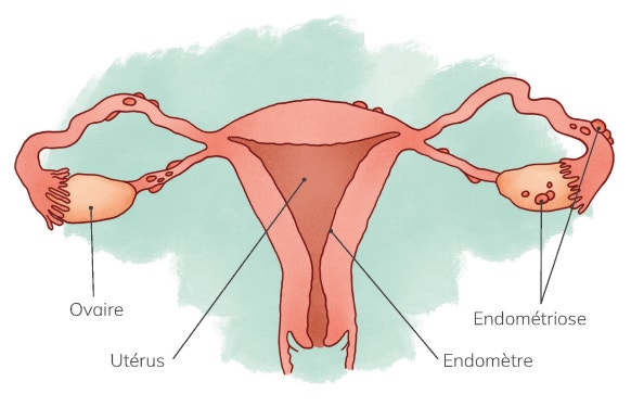 Utérus atteint d’endométriose
