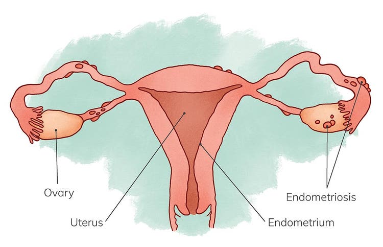 Uterus with endometriosis