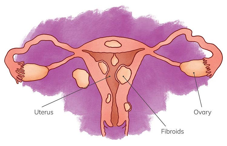 Uterus with fibroids